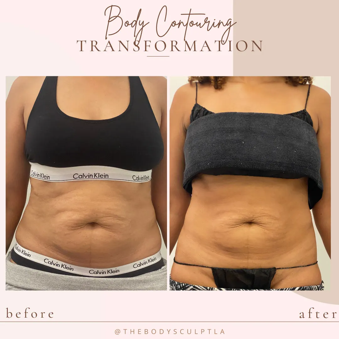 Before and after body contouring of the abdomen, front view
