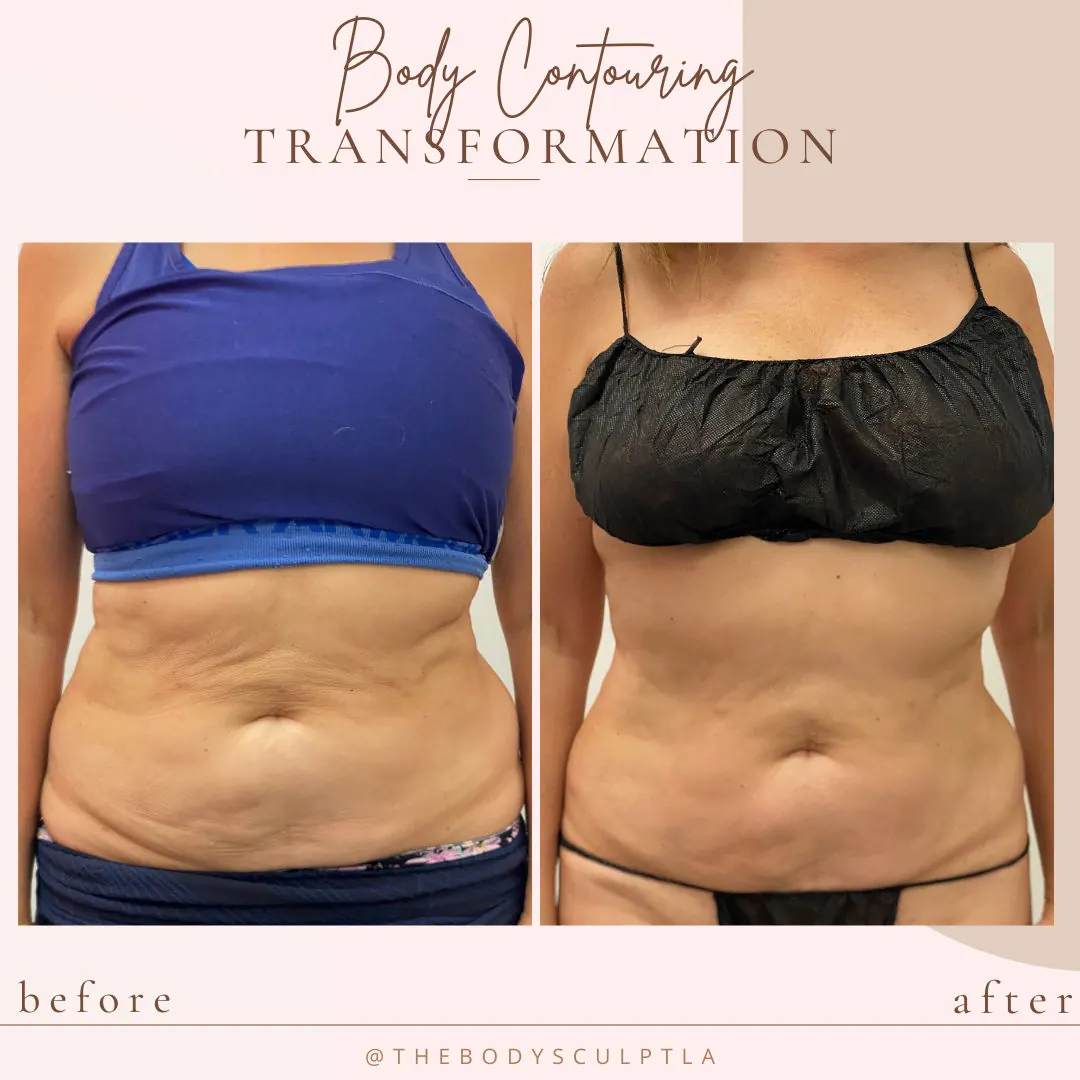 Before and after body contouring of the abdomen, front view