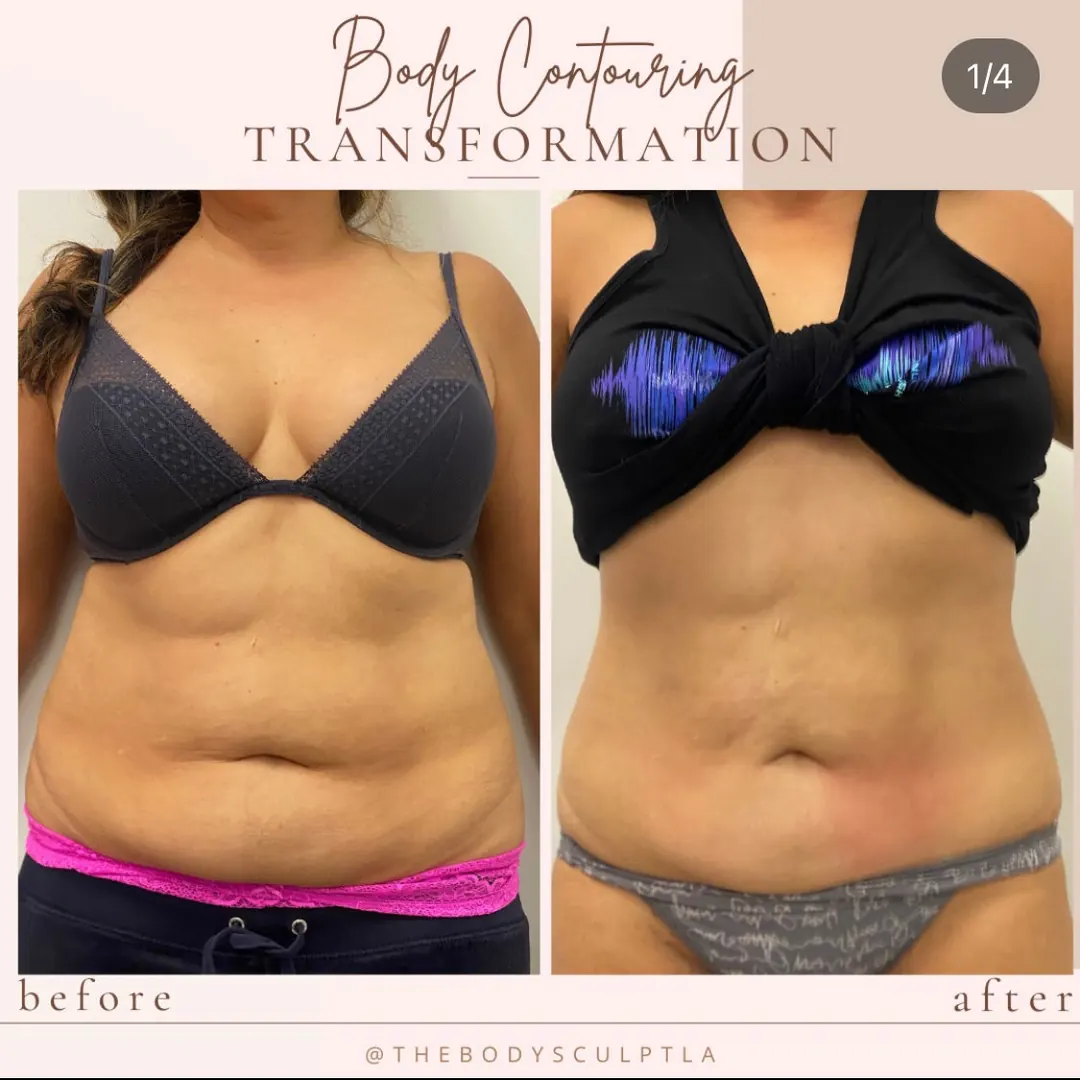 Before and after body contouring of the abdomen, front view