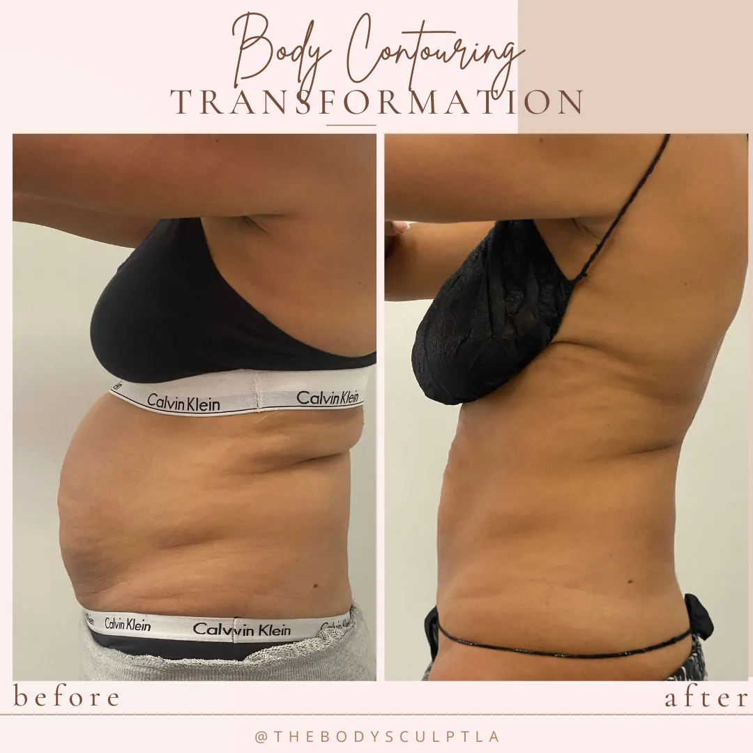 Before and after body contouring of the waist and abdomen, side view
