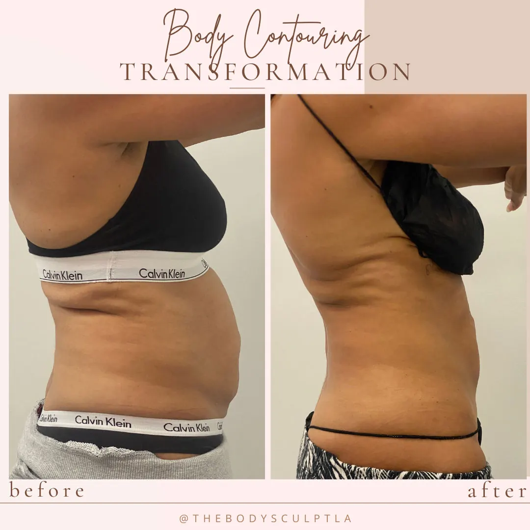 Before and after body contouring of the waist and abdomen, side view