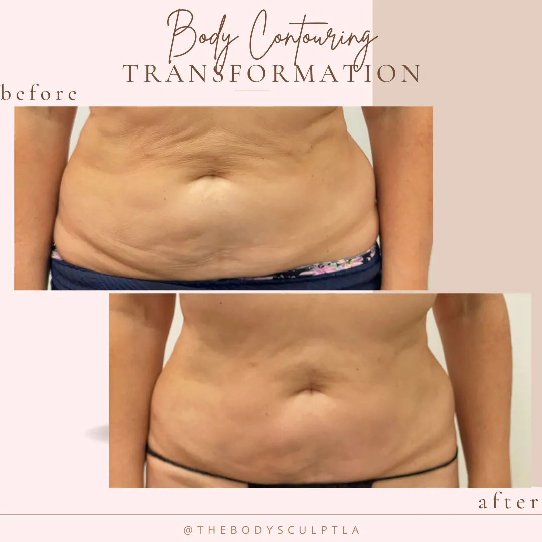 Before and after body contouring of the lower abdomen, close view